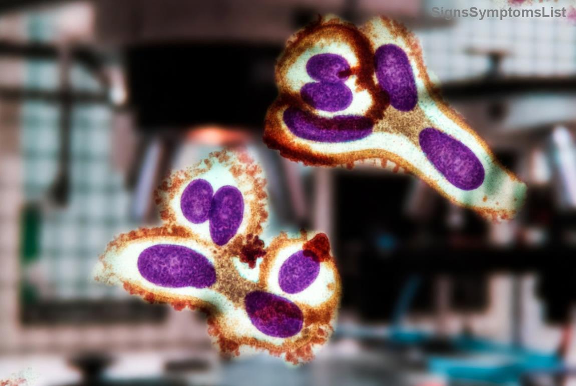 Diagram illustrating early-stage stomach cancer confined to the inner lining