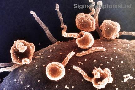 Il Cancro al Polmone di Stadio 3 è Curabile con Terapia Combinata? Scopri le Speranze e le Strategie Vincenti