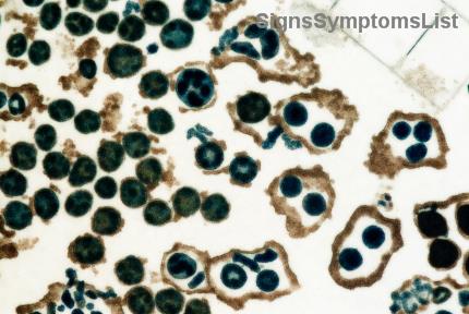 Leukemie Vermoeidheid Verslaan: Kleine Levensstijlveranderingen met Groot Effect