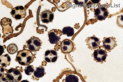 ¿Es Curable el Cáncer de Tiroides Anaplásico? Esperanza y Tratamientos Efectivos