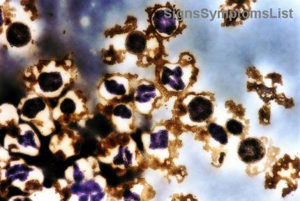 Gérer la Fatigue de la Leucémie : Petits Changements de Vie pour un Impact Majeur