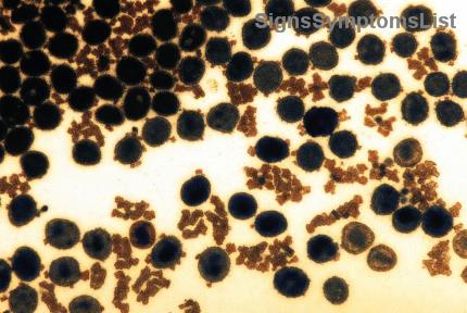 Ist Stadium-3-Lungenkrebs mit Kombinationstherapie heilbar? Hoffnung und moderne Ansätze