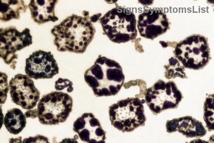 4기 자궁경부암은 완치될 수 있을까? 희망의 빛을 찾는 가이드
