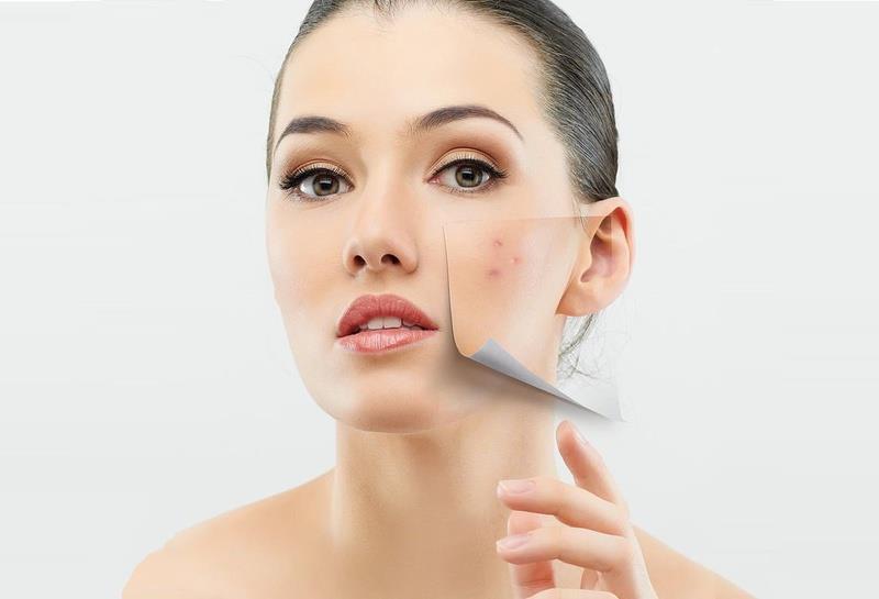 L'acne può andare via da sola?