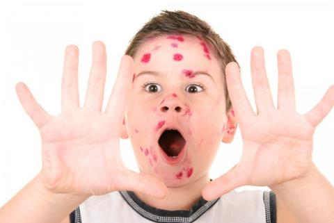 Learn about hand, foot and mouth disease in children – You need to know these 4 things