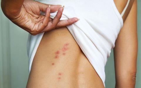 Chickenpox is what disease? How dangerous is chickenpox during pregnancy?