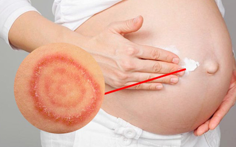Опасен ли стригущий лишай при беременности?  Как предотвратить?