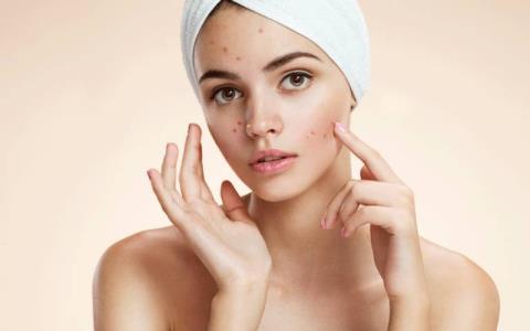 Top 5 most effective summer moisturizers for acne skin