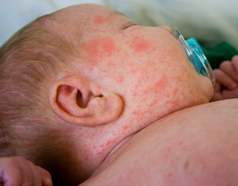 赤ちゃんのために麻疹、おたふく風邪、風疹の予防接種のスケジュールを立てておいてください。