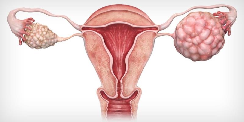 Kanser ovari peringkat 3: Rawatan dan prognosis