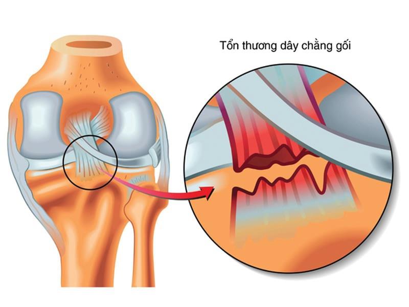 La déchirure du ligament croisé antérieur nécessite-t-elle une intervention chirurgicale ?