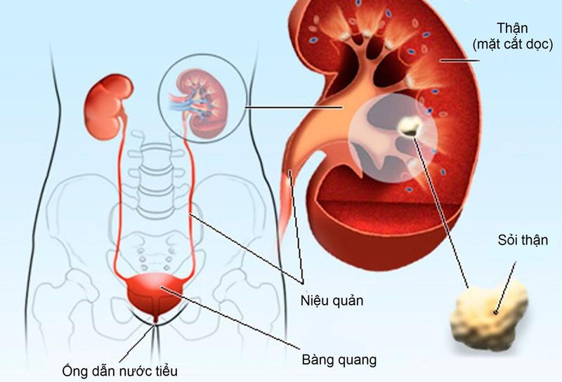 Traditional medicine treats kidney stones at the root