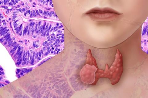 What is thyroid cancer? What fruit should you eat if you have thyroid cancer?