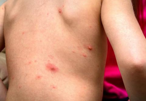 What does shingles look like?
