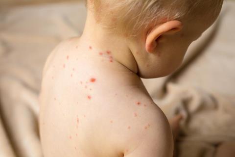 How long does chickenpox take to heal? Typical symptoms of chickenpox recovery