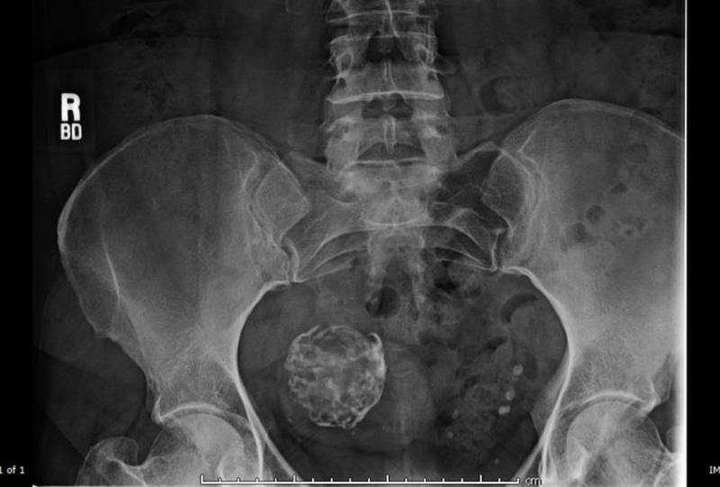 The danger of calcified uterine fibroids