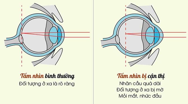 What is false myopia?  How to know?