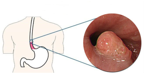 Quali sono le cause della papillomatosi esofagea? Modi per trattare e prevenire la papillomatosi esofagea