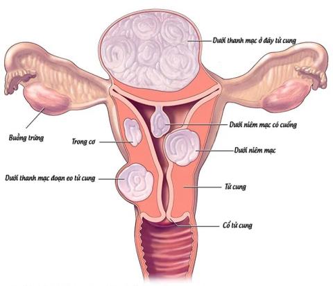 Het gevaar van verkalkte baarmoederfibromen