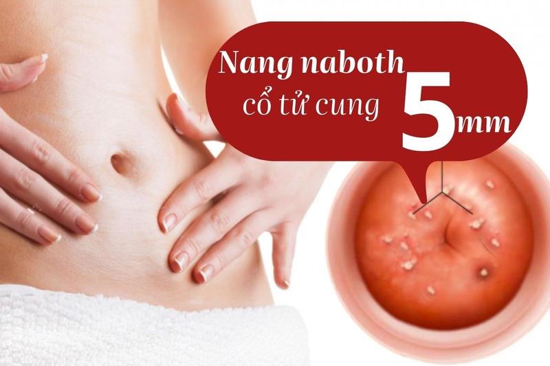 Cos'è una ciste nabotica?  Brucia la ciste di naboth per quanto tempo ti astendi dal sesso?