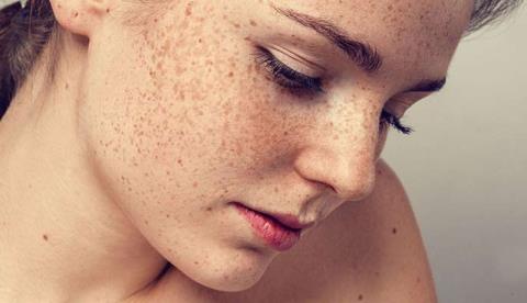 Are freckles spread? Factors affecting the density of freckles