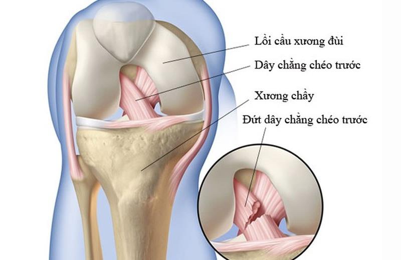 เอ็นไขว้หน้าฉีกต้องผ่าตัดหรือไม่?