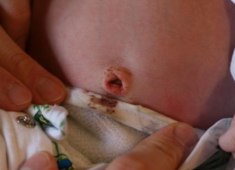 Is bleeding in newborn umbilical cord dangerous?