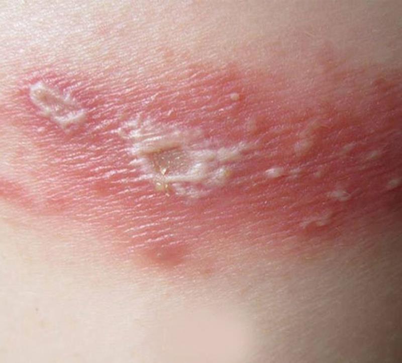 Distinguishing shingles and three compartment ants: Wounds and treatment