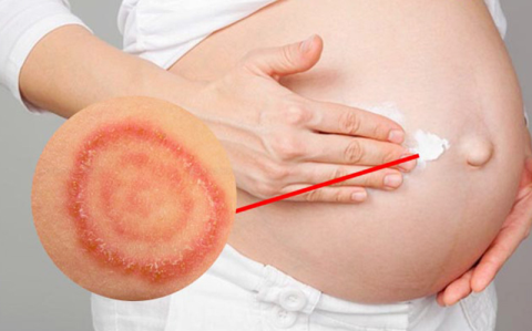 Опасен ли стригущий лишай при беременности? Как предотвратить?