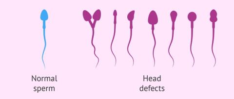 What is Sperm Defect? How to improve sperm quality?