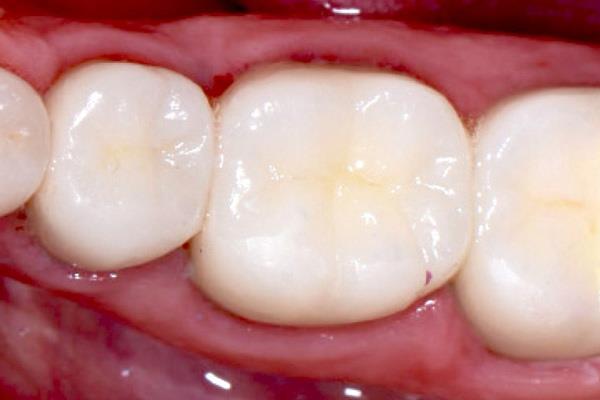 Obturations dentaires et choses à savoir