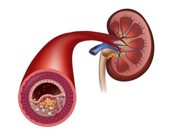 腎動脈狹窄：表現、診斷和治療