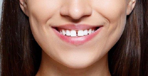 Что такое фарфоровый винир?  Вам нужно точить зубы?