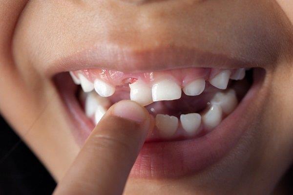 Wat moeten ouders doen als een kind losse tanden heeft?
