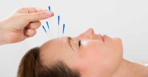Acupuncture for headaches: effects, ways of acupuncture and notes