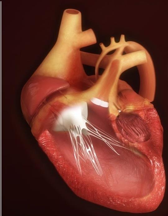 Síndrome do coração esquerdo hipoplásico: causas, sintomas e tratamento