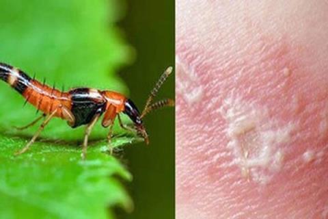 Treatment and prevention of contact dermatitis caused by ants