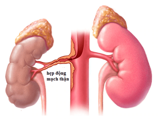 Stenosi dell'arteria renale: manifestazioni, diagnosi e trattamento