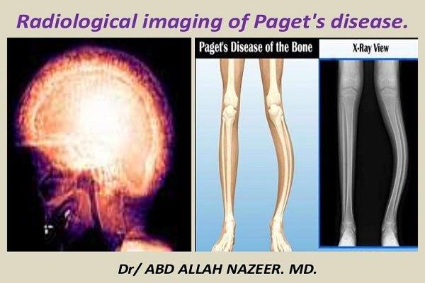 Paget's Bone Disease: Causes, Symptoms, and Treatment