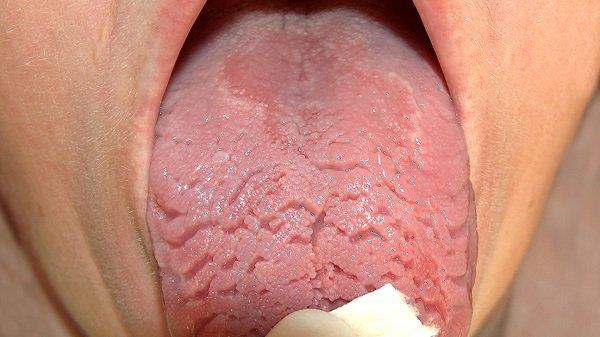 Why do I have cracks on my tongue?