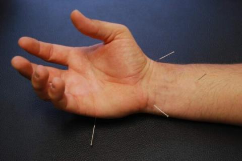 การฝังเข็มสำหรับอาการปวดข้อมือ: ผลกระทบ วิธีการฝังเข็ม และหมายเหตุ