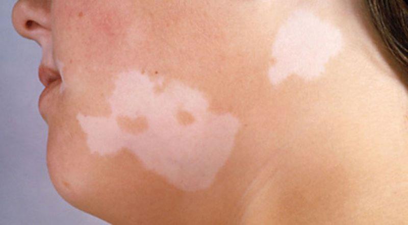 Vitiligo: Ursachen, Symptome, Diagnose