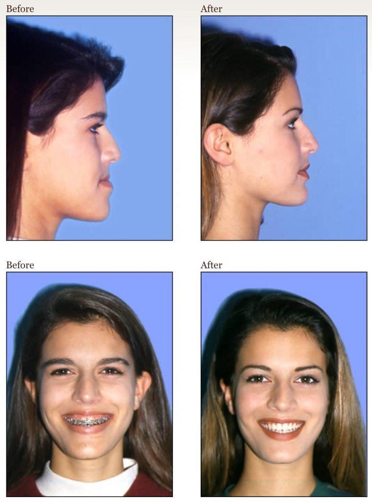 ผลของการจัดฟันในการเปลี่ยนรูปหน้า