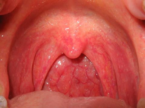 Acute laryngitis: What you need to know!