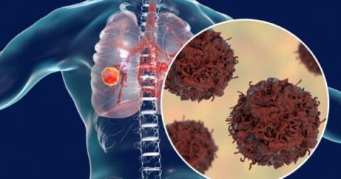 Lung cancer: Symptoms, diagnosis and treatment