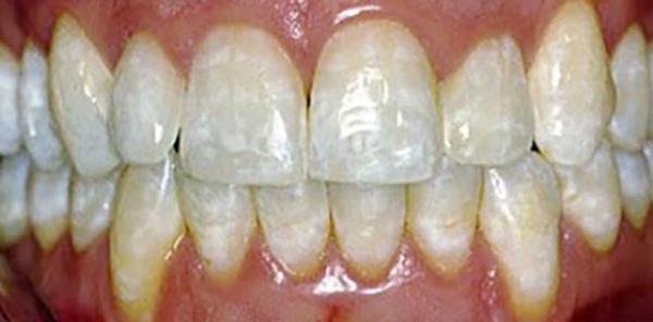 어린이의 노랗고 변색 된 치아 : 원인, 치료 및 예방