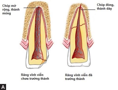 Root canal treatment in childrens developing permanent teeth
