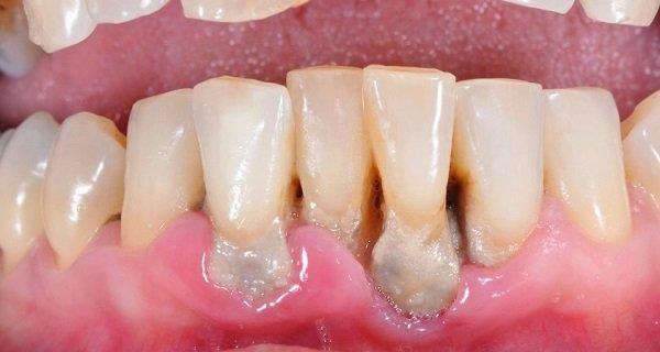 Diş eti çekilmesi: Nedenleri, önlenmesi ve tedavisi