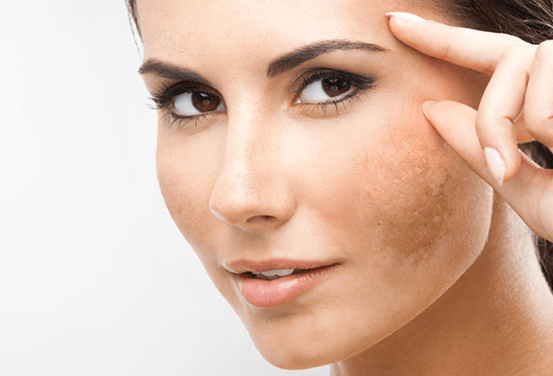 如何正確護理黃褐斑皮膚？