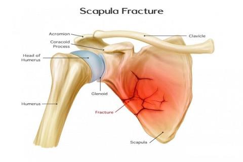 Is shoulder fracture dangerous or not? How is the treatment?